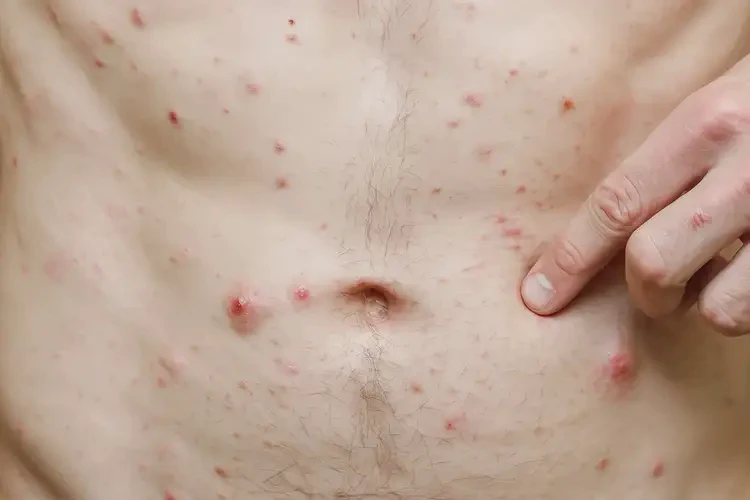 青年人肚子長濕疹能不能徹底自愈(圖4)