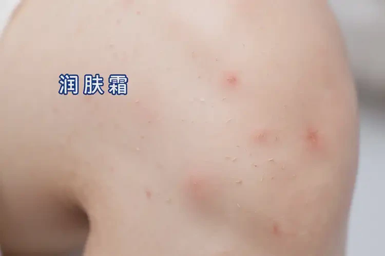 小兒大腿偶爾起濕疹可以徹底自愈嗎(圖4)