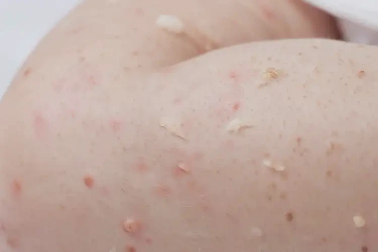 嬰幼兒小腿上偶爾起濕疹能夠徹底治愈嗎(圖4)