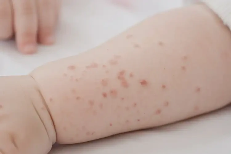 寶寶手臂上偶爾長濕疹可以徹底自愈嗎(圖4)