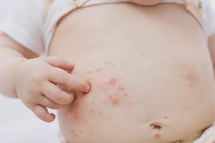 嬰幼兒肚子上容易長(zhǎng)濕疹可以徹底自愈嗎(圖4)