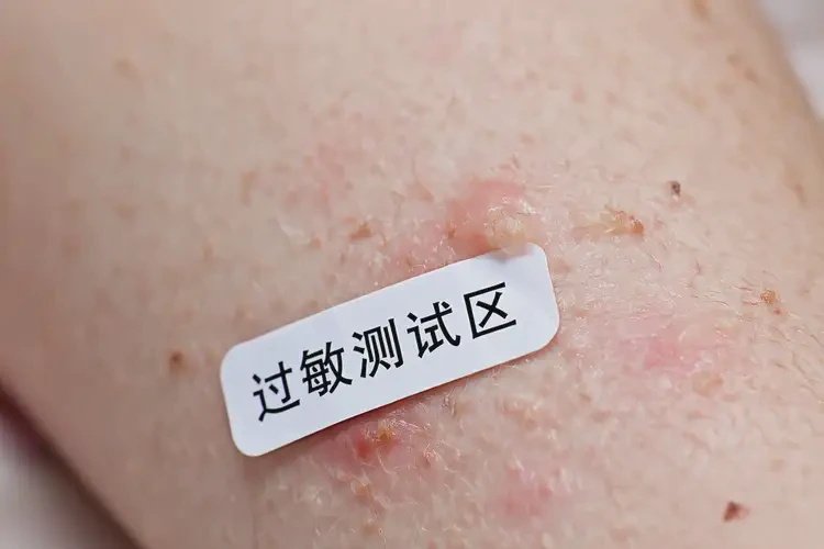 兒童手臂上長濕疹能靠自己自愈嗎(圖4)