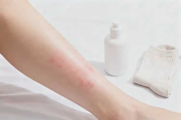 大學(xué)生小腿上偶爾起濕疹可不可以徹底自愈(圖3)