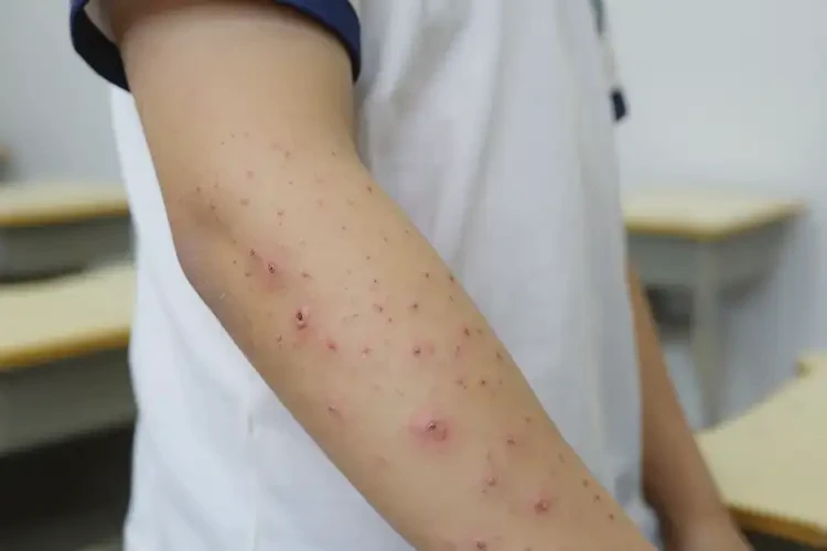 青少年手臂上容易起濕疹不管它會自己好嗎(圖4)