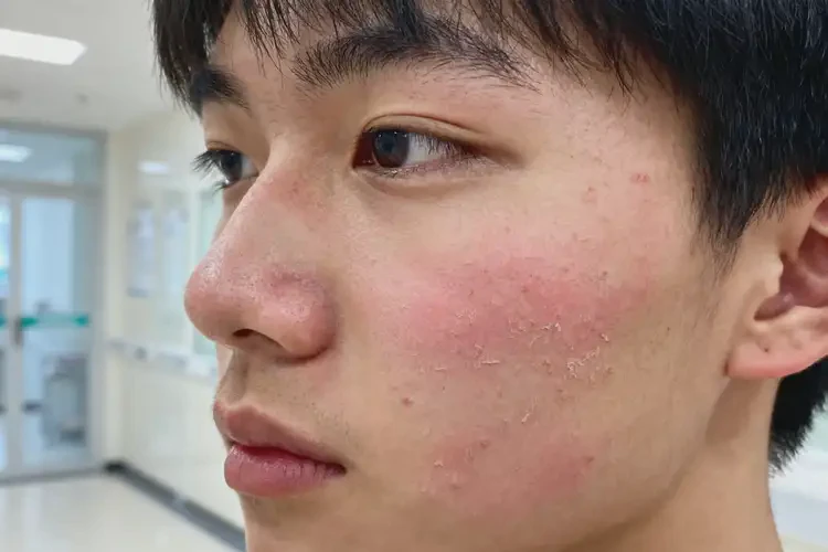 青年人面部有濕疹可不可以徹底自愈(圖2)