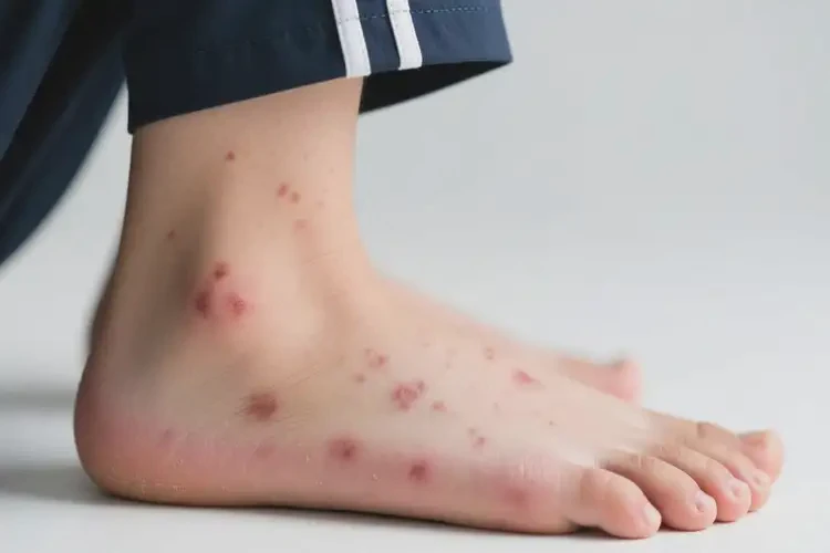 中學生腳上容易長濕疹不管它會自己好嗎(圖4)