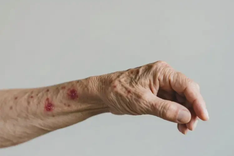 老人手臂上長(zhǎng)濕疹不管它會(huì)自己痊愈嗎(圖3)
