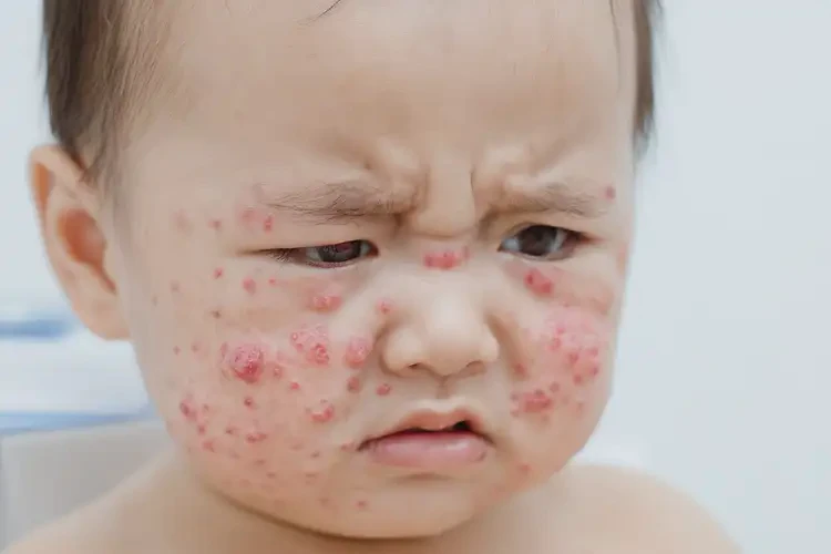 嬰幼兒臉上容易起濕疹能徹底自愈嗎(圖4)