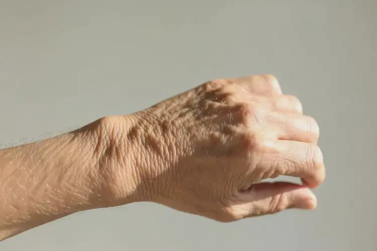 老年人身上偶爾長濕疹可不可以徹底自愈(圖2)