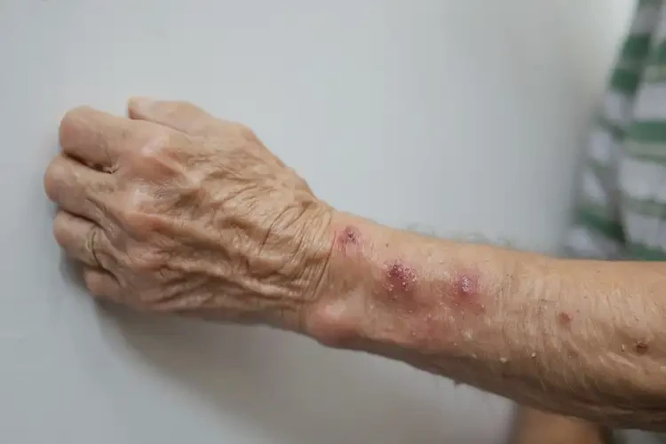 高龄老人手臂偶尔长湿疹能不能根治(图4)