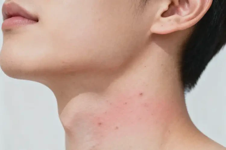 青年人脖子上偶爾起濕疹可以徹底自愈嗎(圖4)