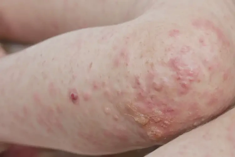 孩子小腿容易長濕疹可以徹底自愈嗎(圖2)