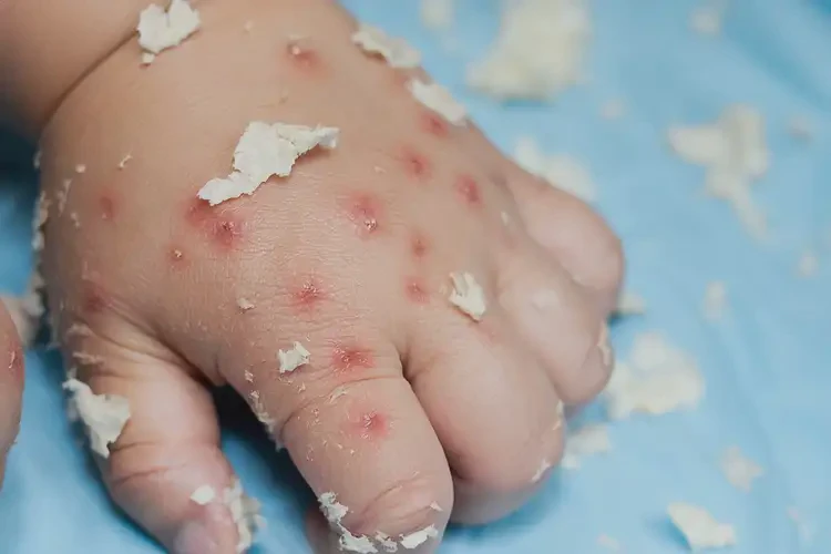 小孩身上起濕疹能靠自己自愈嗎(圖3)