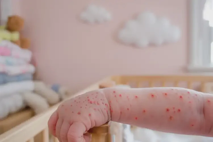 新生兒手臂容易長濕疹能徹底自愈嗎(圖4)