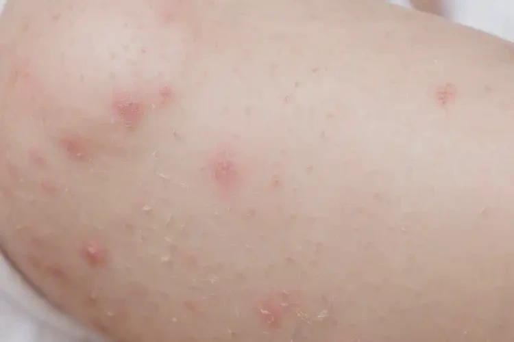 小兒小腿上起濕疹能靠自己自愈嗎(圖4)