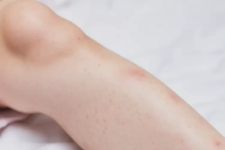 小兒小腿上起濕疹能靠自己自愈嗎(圖1)