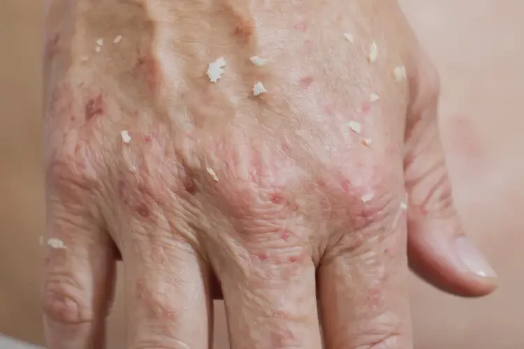女性手上容易長濕疹不管它會自己好嗎(圖4)
