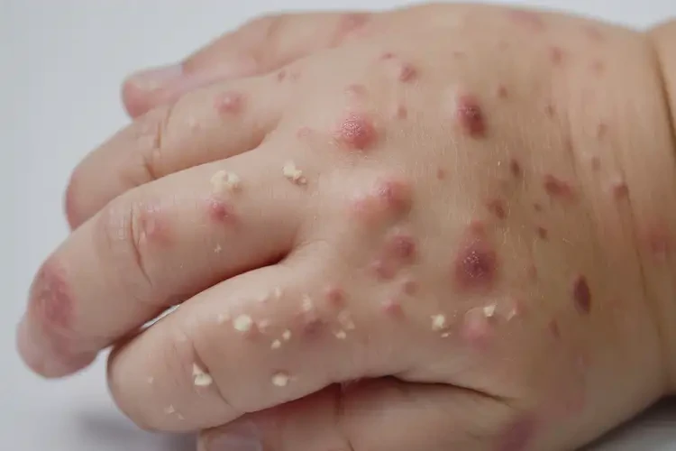 幼兒手上容易起濕疹能徹底自愈嗎(圖4)
