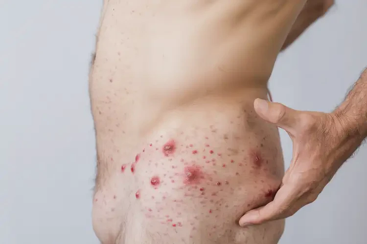 男人屁股上容易長濕疹能夠徹底治愈嗎(圖4)