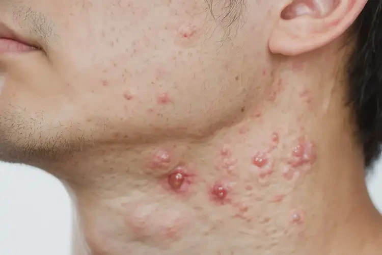 男生脖子上容易起濕疹能夠徹底治愈嗎(圖4)