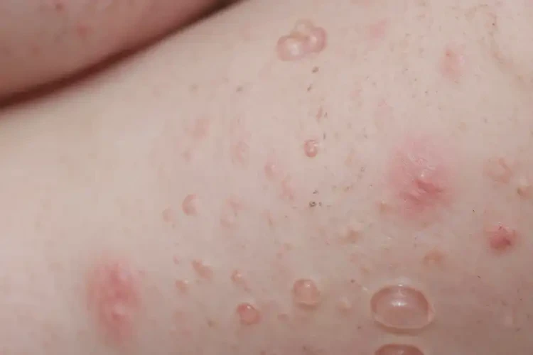 新生兒脖子上出現(xiàn)濕疹可以徹底自愈嗎(圖3)