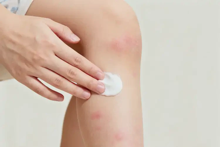 小兒小腿長濕疹不管它會自己自愈嗎(圖4)