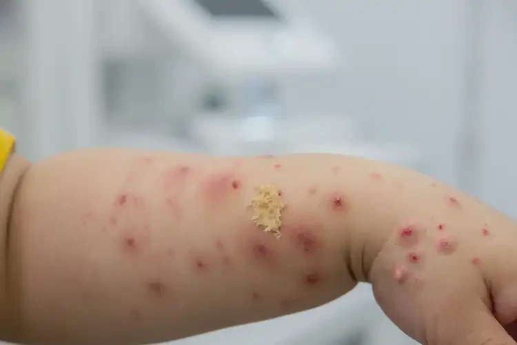 孩子手臂经常长湿疹不管它会自己好吗(图1)