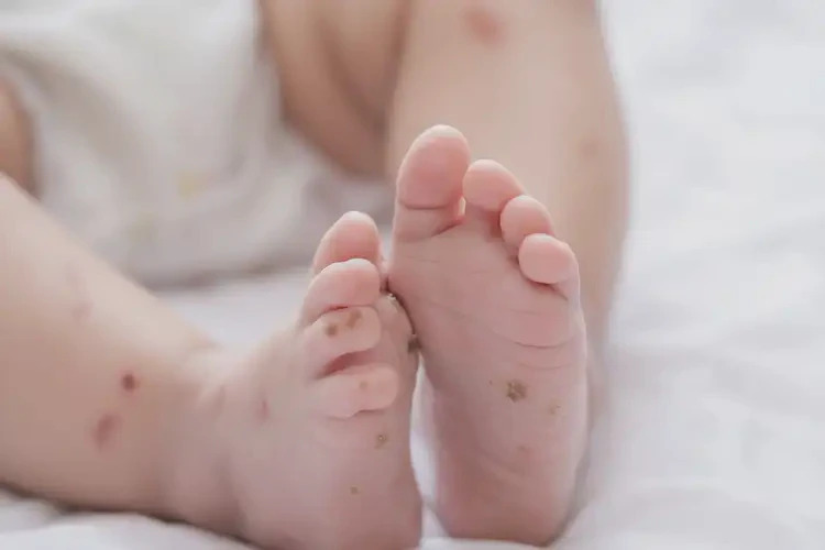 嬰兒腳上偶爾起濕疹可以徹底自愈嗎(圖4)