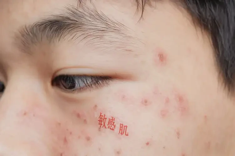 青少年肚子上偶爾起濕疹可不可以徹底自愈(圖4)