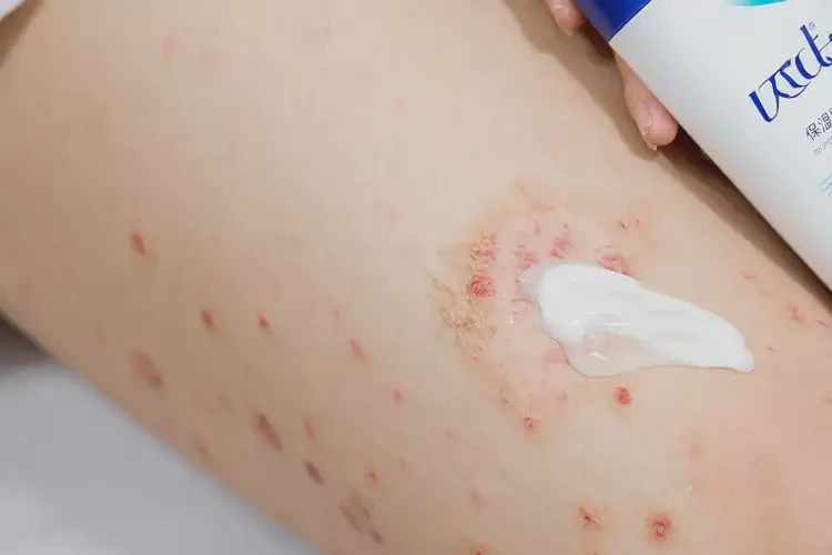 女人大腿上容易起濕疹不管它會自己痊愈嗎(圖3)
