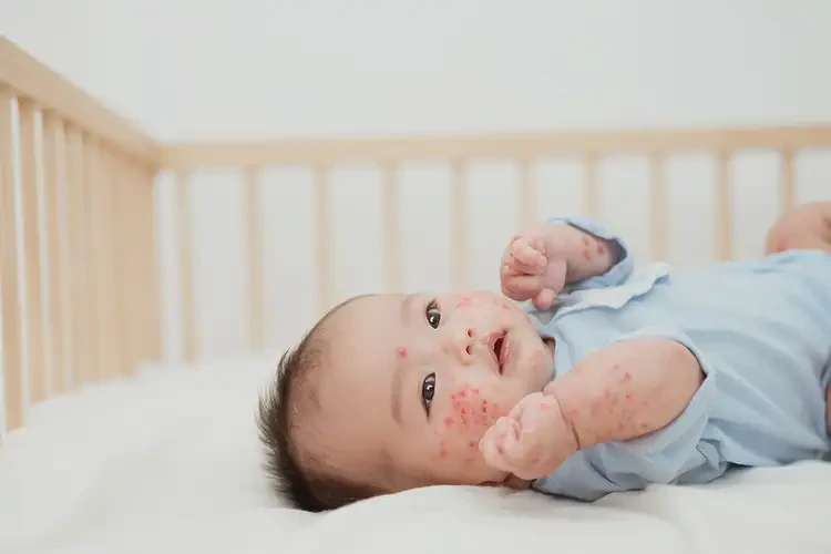 寶寶屁股經常長濕疹可以徹底自愈嗎(圖4)