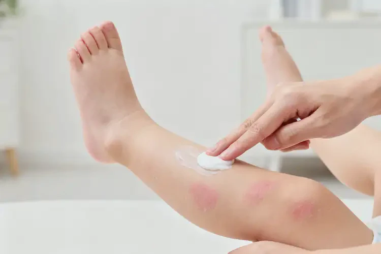 幼兒四肢出濕疹能夠徹底治愈嗎(圖1)