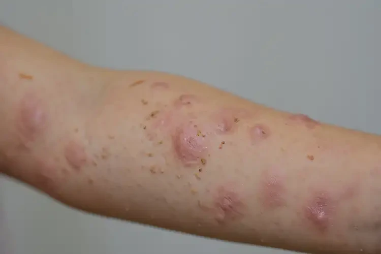 孩子身上有濕疹不管它會(huì)自己自愈嗎(圖4)