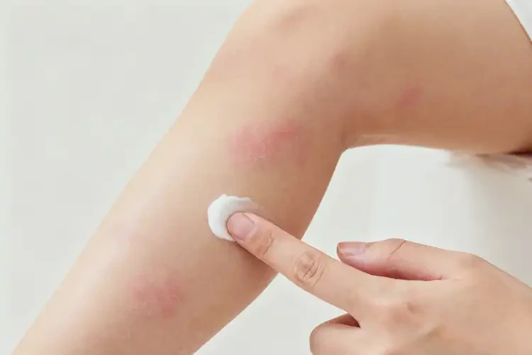 小兒小腿長濕疹不管它會自己自愈嗎(圖3)