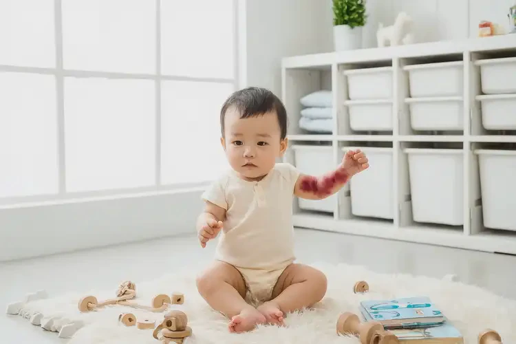 寶寶手臂上經(jīng)常起濕疹能靠自己自愈嗎(圖1)