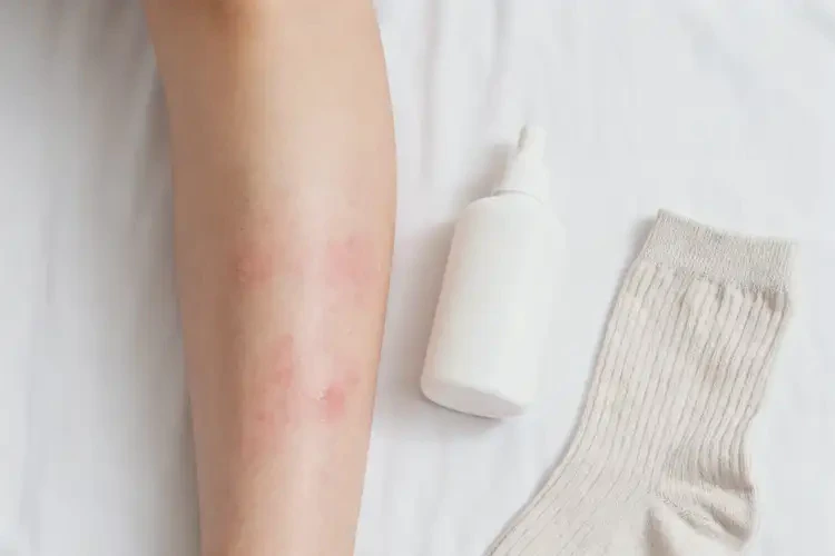 大學(xué)生小腿上偶爾起濕疹可不可以徹底自愈(圖1)