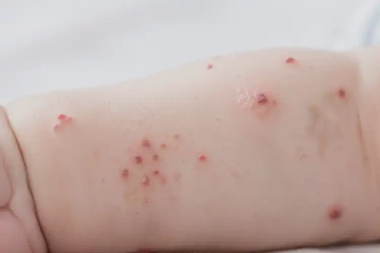 婴儿手臂经常长湿疹能靠自己自愈吗(图4)