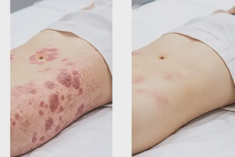 兒童肚子上容易起濕疹可以徹底自愈嗎(圖1)