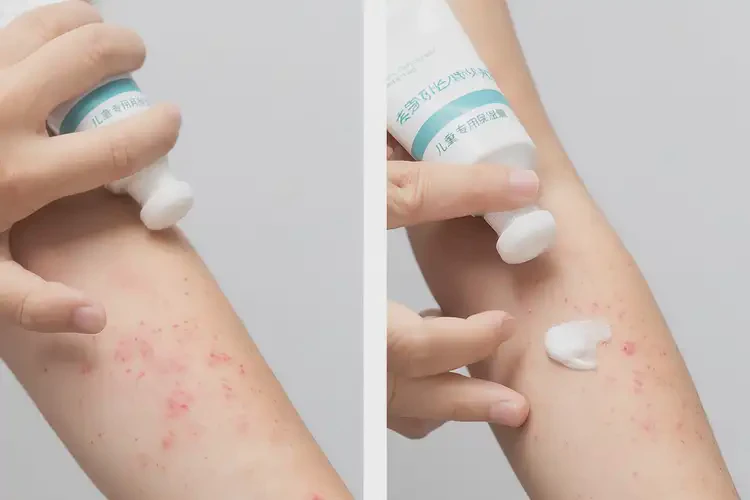 孩子手臂偶爾長濕疹不管它會自己自愈嗎(圖3)