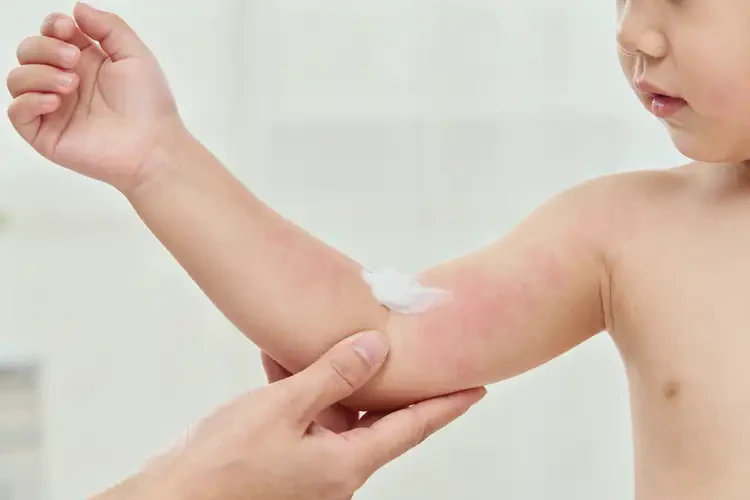 幼儿手臂上有湿疹不管它会自己好吗(图2)