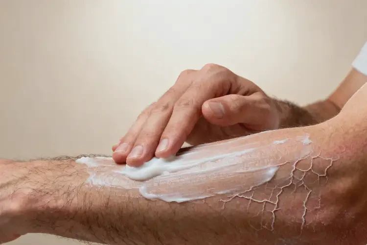 男生全身容易長濕疹可不可以徹底自愈(圖2)