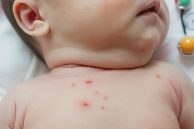 新生兒脖子上長(zhǎng)濕疹不管它會(huì)自己痊愈嗎(圖4)