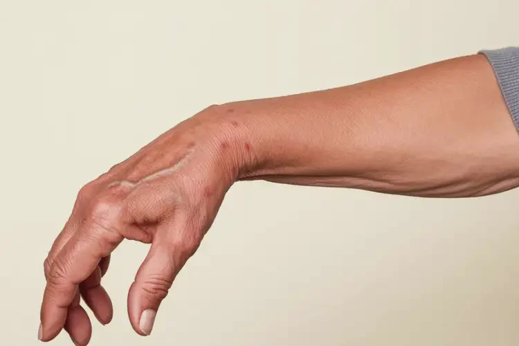 老年人手臂有湿疹不管它会自己自愈吗(图4)