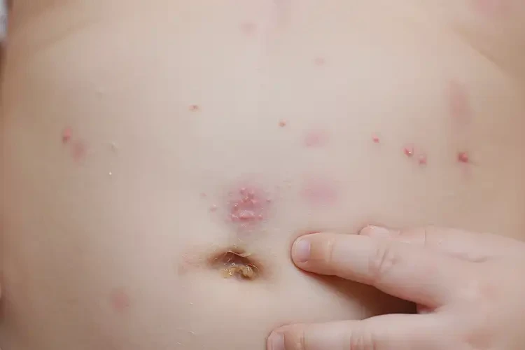 寶寶肚子上容易長濕疹可以徹底自愈嗎(圖4)