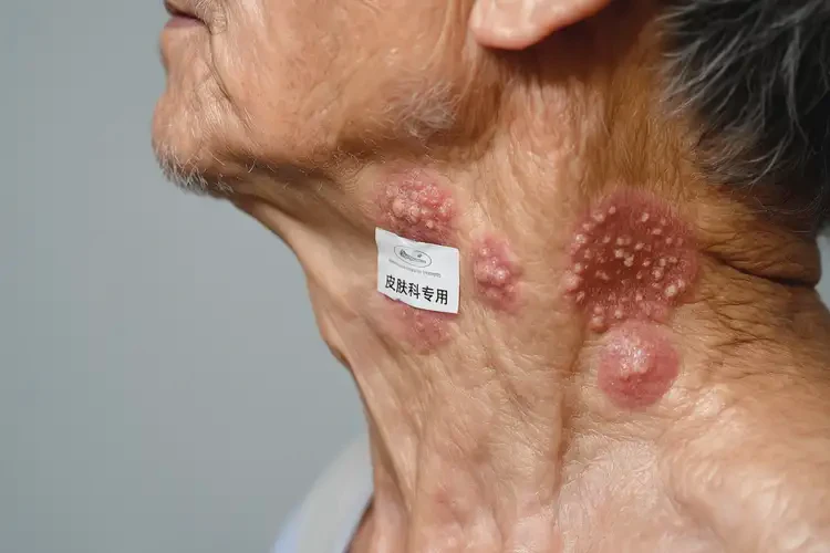 老人脖子偶爾長濕疹可不可以根治(圖4)