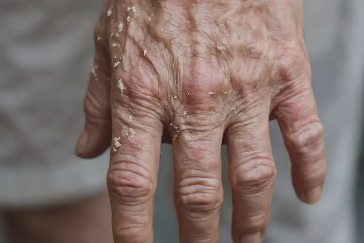 老人手上偶爾長(zhǎng)濕疹可以徹底自愈嗎(圖4)