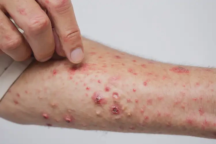 男人屁股偶爾起濕疹能不能根治(圖4)