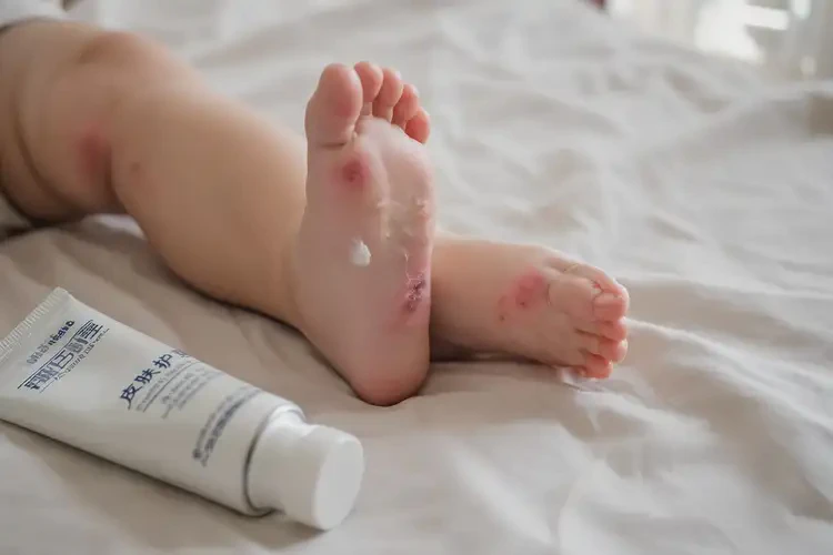 嬰兒腳上有濕疹能夠徹底治愈嗎(圖3)
