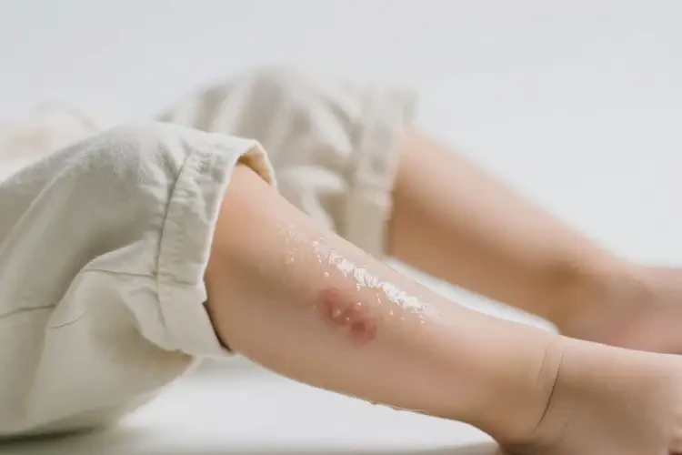 小孩小腿上經(jīng)常長濕疹可不可以徹底自愈(圖3)