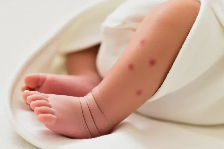 新生兒四肢偶爾起濕疹能徹底自愈嗎(圖4)